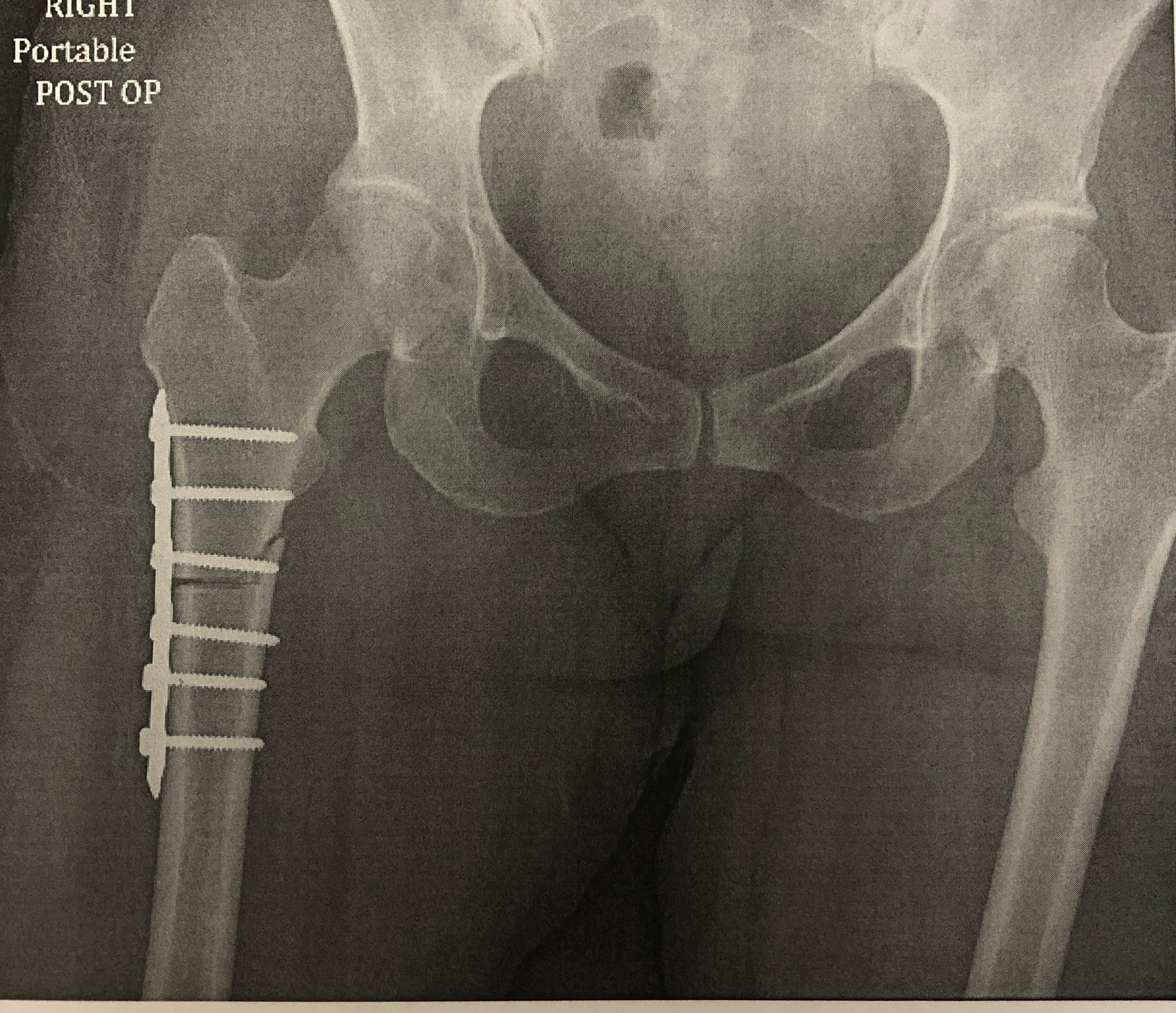 femoral osteotomy